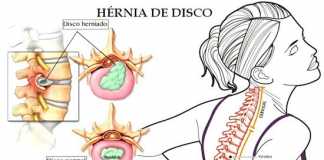 hernia-discal