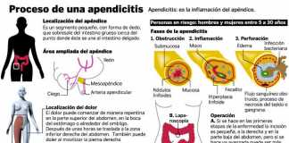 apendicitis