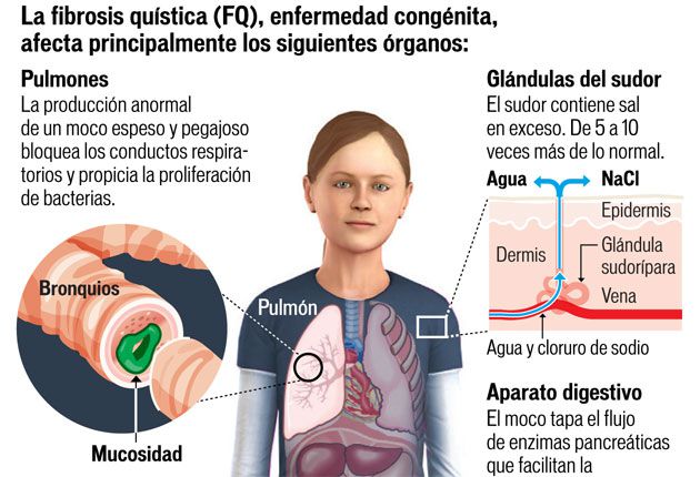 fibrosis quistica