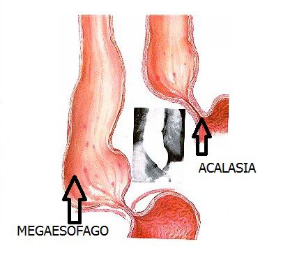 Acalasia, un problema de esófago bastante frecuente acalasia-esofago
