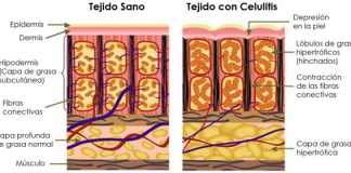 celulitis1