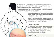culebrilla-herpes