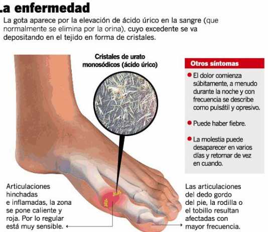 El consumo de alcohol eleva el ácido úrico gota