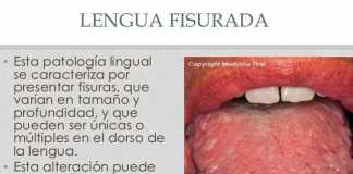 lenguaconfisuras