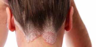 psoriasis-cabello