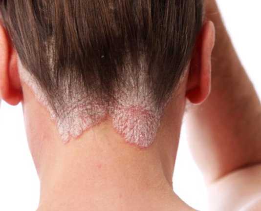 psoriasis-cabello