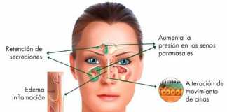 sinusitis