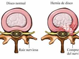 nerviocomprimido