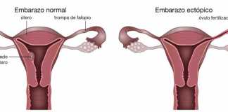 embarazo-ectopico