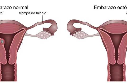 Consejos para prevenir un embarazo ectópico embarazo-ectopico