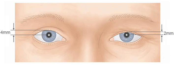 ptosis