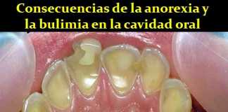 anorexia-dental