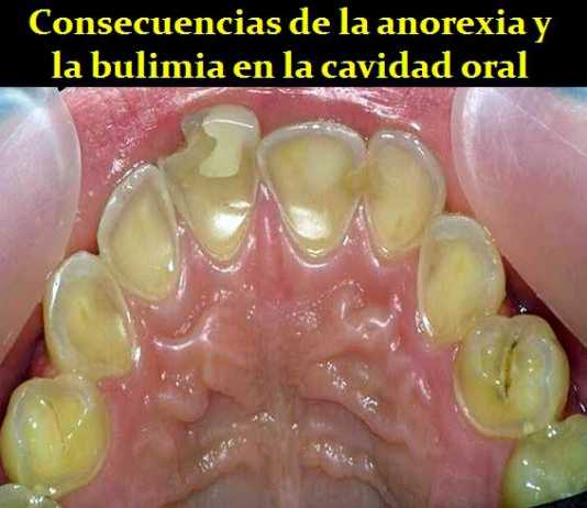 anorexia-dental
