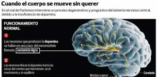 parkinson