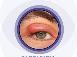 blefaritis