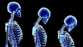 Cómo-prevenir-la-osteoporosis-de-forma-temprana