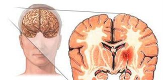 El-ictus-es-la-segunda-causa-de-muerte-en-mayores-de-60-años