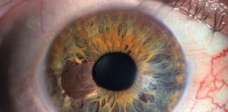Enfermedad-ojos
