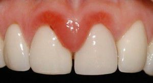 La gingivitis manipula el sistema inmunológico La-gingivitis-manipula-el-sistema-inmunológico