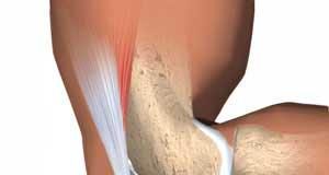 Los-diferentes-tipos-de-bursitis-que-afectan-nuestra-salud
