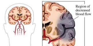 Tratamiento-y-tipos-de-apraxia