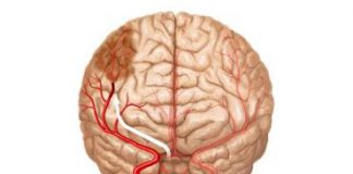 accidente_cerebrovascular
