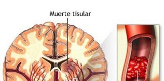 aplopejias-tipo-a