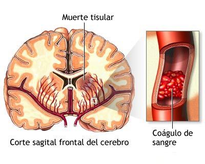 aplopejias-tipo-a