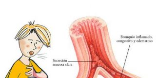 bronquitis