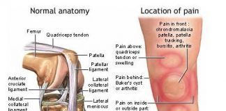 bursitis