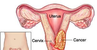 cancer-cervical