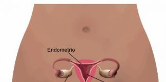 cancer-cervix