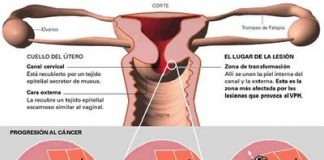 cancer-cuello-utero