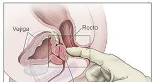 cancer-prostata