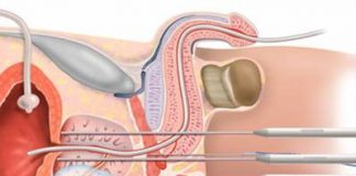 cancer-prostata-tratamiento