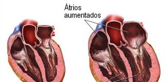 cardiomegalia