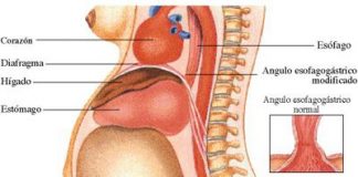 diabetes_gestacional