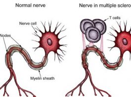 esclerosis-multiple