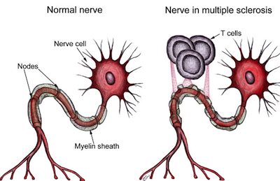 esclerosis-multiple