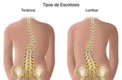 escoliosis-tipos