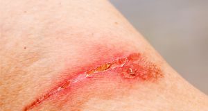 heridas