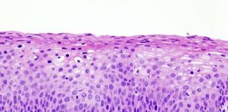 neoplasia