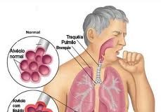 neumonia