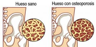 osteoporosis