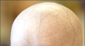 progeria