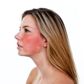 Las bacterias de ácaros en la piel pueden causar la rosácea rosacea