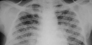 tuberculosis
