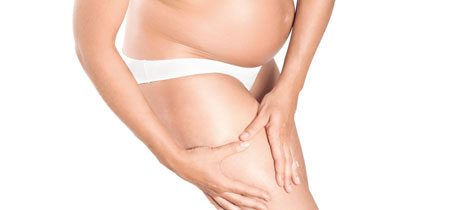 Varices en el embarazo varices