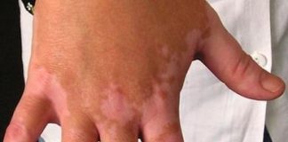 vitiligo1